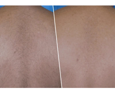 Skin Treatment Before and After Pictures